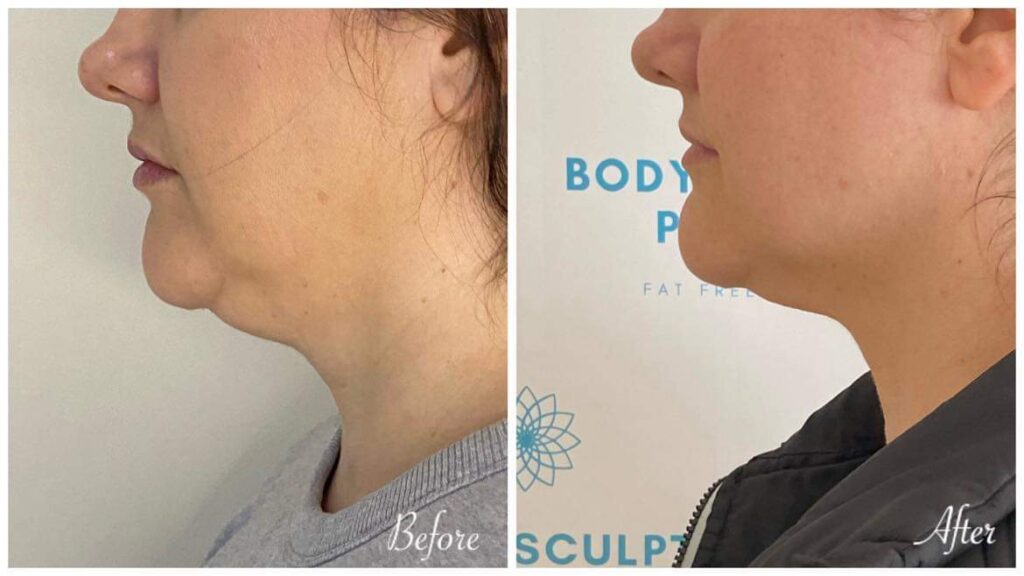 Before and after fat freezing treatment on double chin – non-invasive cryolipolysis for chin fat reduction and jawline definition