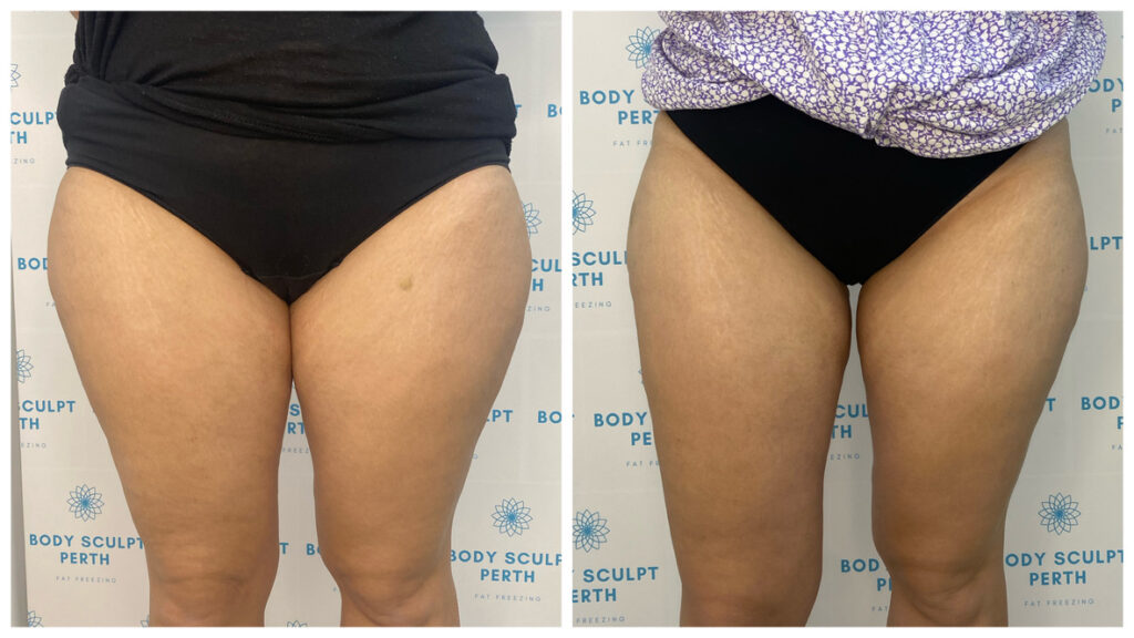 Before and after fat freezing treatment on inner thighs – visible reduction of inner thigh fat using non-invasive cryolipolysis