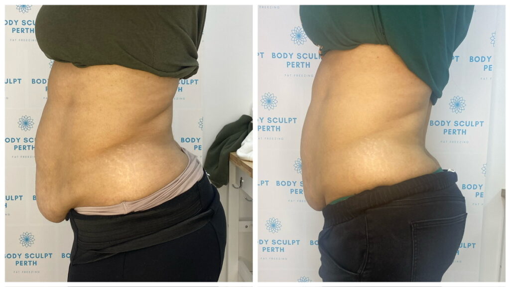Amazing results after tummy fat freezing – non-invasive cryolipolysis treatment showing flatter stomach and reduced belly fat in before and after comparison