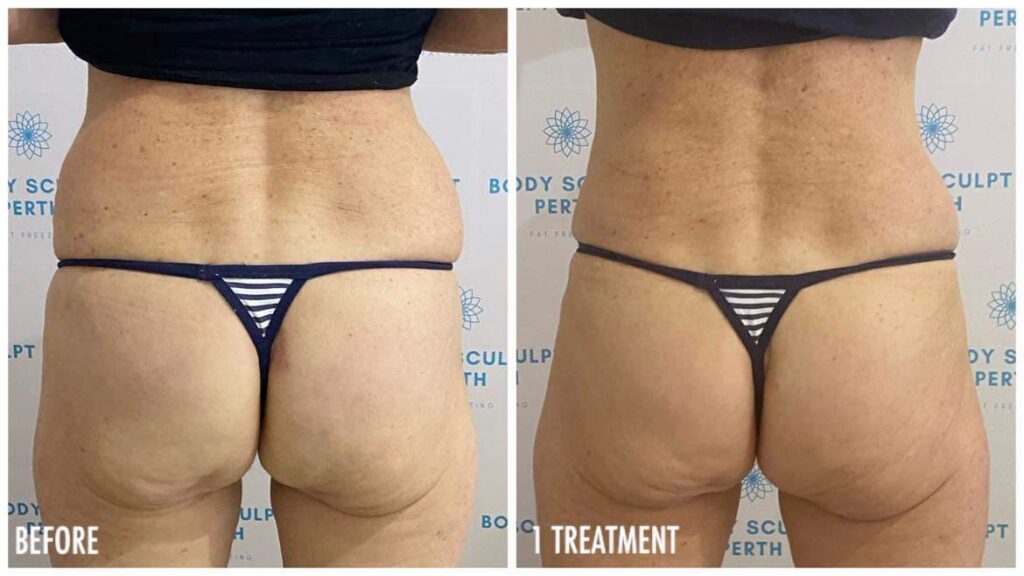 Before and after fat freezing treatment on love handles showing visible reduction in love handle fat using cryolipolysis technology
