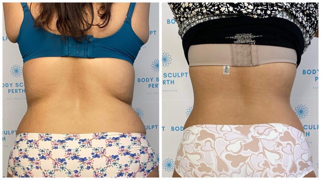Before and after fat freezing treatment showing reduction of bra line fat on the upper back using non-invasive cryolipolysis
