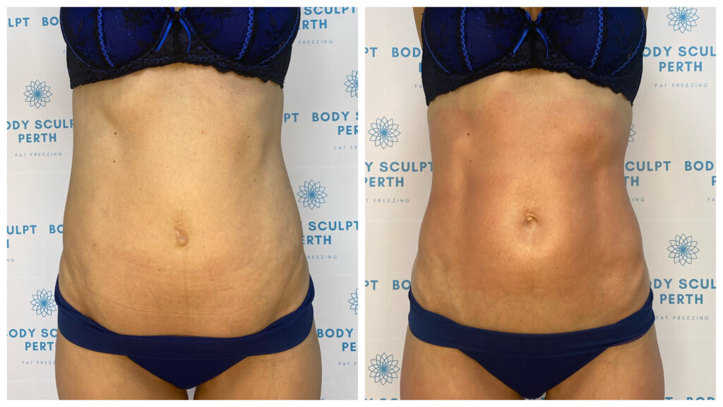 Tummy slimming treatment to reduce fluid retention and abdominal bloating using lymphatic drainage and fat-burning therapy – before and after results shown