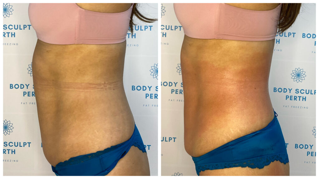 Tummy slimming treatment using fat-burning and lymphatic drainage to reduce abdominal bloating, tone the midsection, and sculpt the waistline – before and after shown
