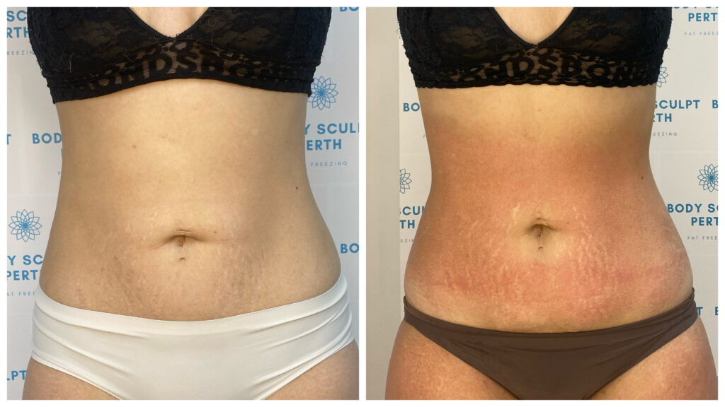 Non-invasive tummy slimming with lymphatic drainage and fat-burning treatment – reduced bloating and firmer midsection visible in before and after photos