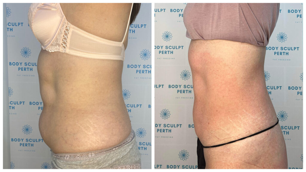 Intensive tummy slimming treatment using lymphatic drainage and fat-burning technology to reduce bloating and contour the waist – visible before and after