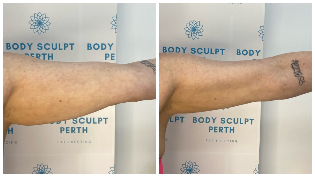 Arm slimming treatment using lymphatic drainage and fat-burning technology to reduce puffiness and sculpt upper arms – before and after photos