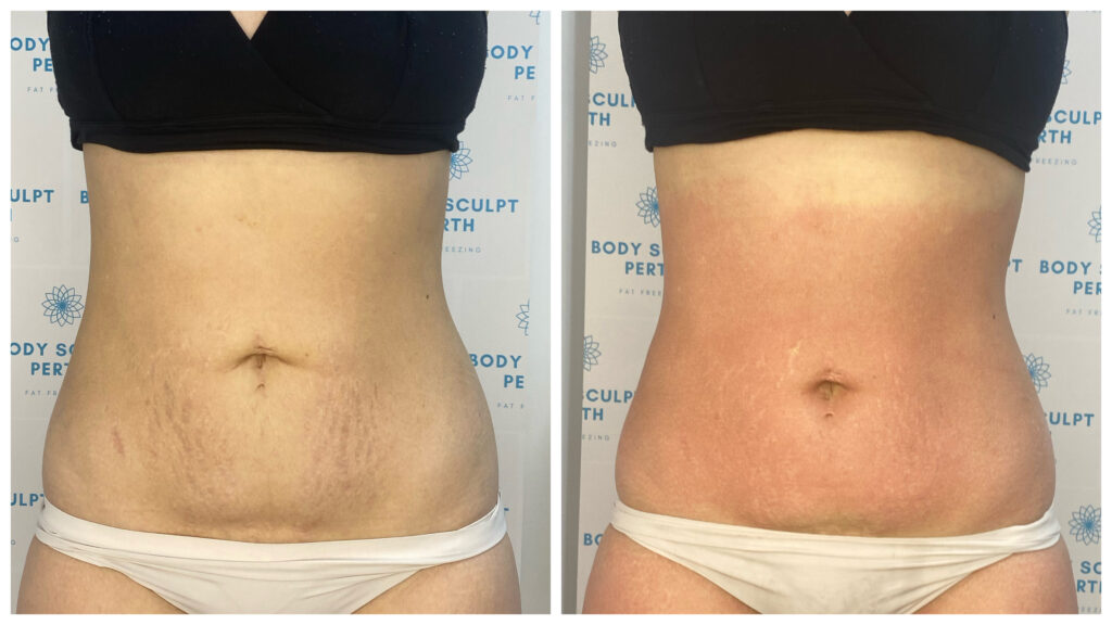 Intensive body slimming with fat-burning and lymphatic drainage – before and after showing reduced bloating and more defined shape