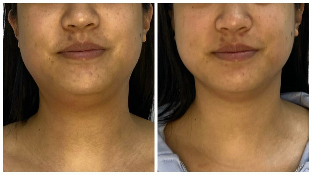 Before and after non-surgical chin reduction using infrared and radio frequency skin tightening for women