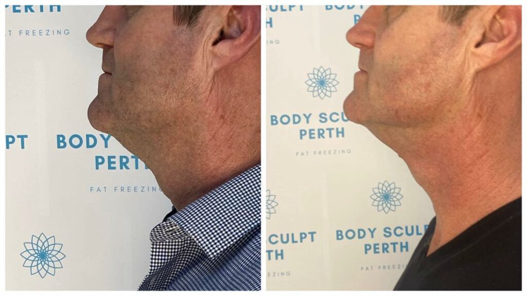 Before and after jawline sculpting for men using infrared and radio frequency skin tightening treatment