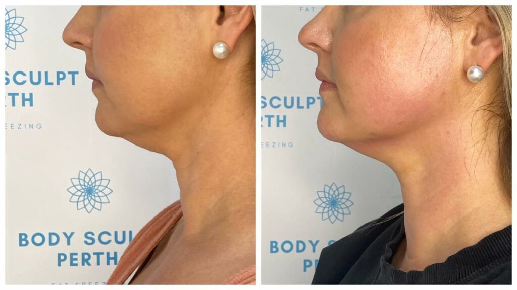 Before and after of sculpted jawline using non-invasive infrared and radio frequency skin tightening treatment