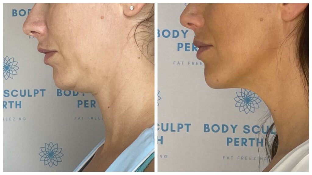 Sculpted jawline before and after using infrared and radio frequency treatment for non-surgical facial contouring