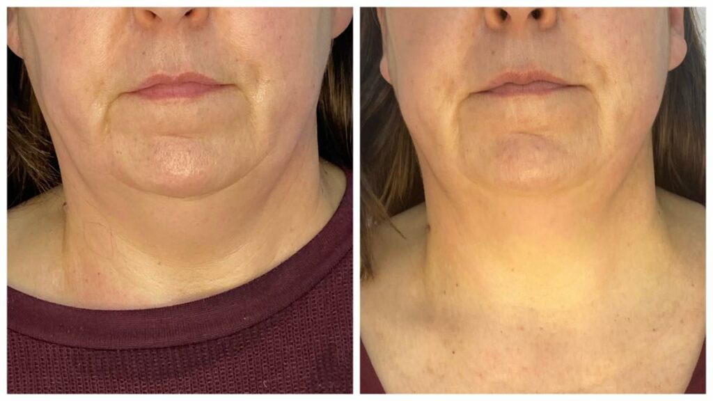 Before and after infrared and radio frequency chin lift treatment showing tighter, smoother skin and improved definition