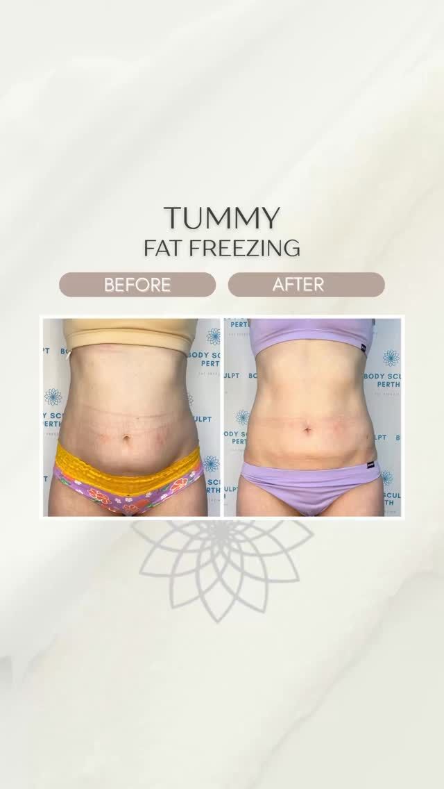 Before & after 3 tummy freezes… and a reminder that results take time 👌

What you’re seeing here isn’t overnight.
Fat freezing works by gradually breaking down fat cells, which your body then naturally eliminates over the following weeks.

That’s why consistency matters.

✔ Treatments spaced correctly�✔ Supporting your body in between�✔ Letting the process actually work

The goal isn’t a quick fix—it’s a real, lasting change in shape. When done properly, the results speak for themselves.

If you’ve been wondering whether it actually works… this is your answer.

Your next step? Just send me a message 💬

#bodysculptperth #fatfreezingperth #bodysculpting #beforeandafter #perthbeauty