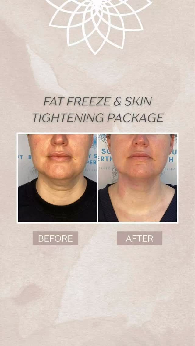 ✨ Before & after ✨

This client’s custom Fat Freezing + Skin Tightening package targeted their chin — reducing stubborn fat and tightening the skin for a sleeker, more defined look.

Every treatment is tailored to you, so we focus on exactly what you want to improve 🤍

✅ Reduce stubborn chin fat
✅ Smooth & tighten
✅ Subtle, natural-looking lift

Curious if a custom chin package could work for you? 
📩 DM us!

#BodySculptPerth #FatFreezing #SkinTightening #ChinSculpting #JawlineLift #PerthBeauty #PerthWellness #PerthSalon #BeforeAndAfter #PerthWomen #PerthLife #SelfCarePerth #NonSurgical #BodyGoalsPerth