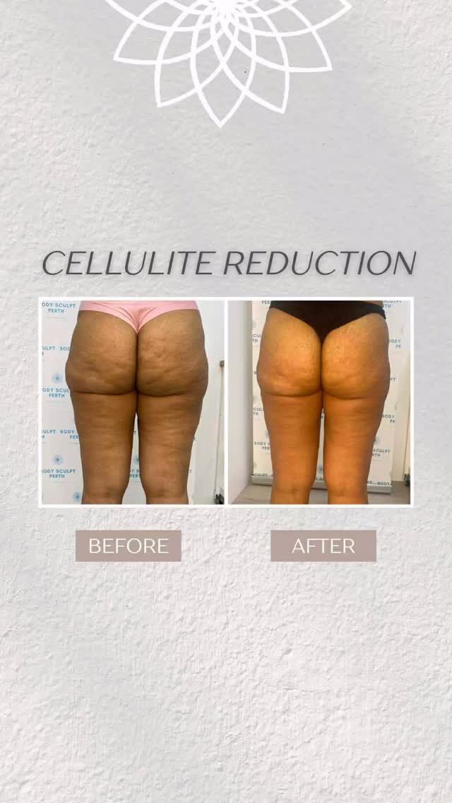 Cellulite reduction looks different for everybody ✨

This before & after progress was achieved with our signature Bum & Back of Legs treatment, which combines multiple technologies to support smoother, firmer-looking skin 💫

Cellulite reduction is a personal journey — no two bodies are the same. That’s why we always recommend coming in to see us in person, so we can assess your body and create a treatment plan that’s best suited to you 🤍

Book a consultation to get started ✨

#cellulitereduction #bodysculptperth #bodysculptingperth #noninvasivetreatments #skinconfidence
