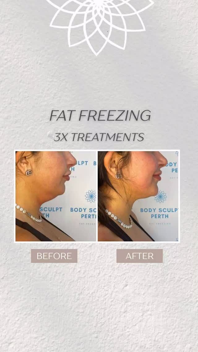 POV: You didn’t think your chin could change this much without surgery…

Our chin fat freezing treatment targets stubborn fullness under the chin — no needles, no downtime, no surgery.

Just a gradual, natural reduction that leaves you looking more snatched, more defined and still completely YOU.

And the best part? Results keep improving over time as your body naturally eliminates the fat cells.

If you’ve been thinking about it… this is your moment.

📩 DM for more info!

#chinfatfreezing #doublechinreduction #jawlinecontour #bodysculptperth #chinfatreduction