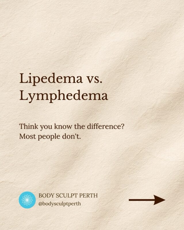 Lipoedema vs Lymphoedema — what’s the difference? 

These two conditions are often confused, but they’re not the same — and understanding the difference matters for proper care and treatment.

✨ Lipoedema
• A chronic condition involving abnormal fat distribution
• Typically affects hips, thighs, legs (sometimes arms)
• Symmetrical (both sides of the body)
• Feet and hands are usually not affected
• Can feel tender, bruise easily, and doesn’t respond well to diet/exercise

✨ Lymphoedema
• Caused by a compromised lymphatic system
• Leads to fluid retention and swelling
• Can affect one or both limbs
• Often includes swelling in the feet or hands
• Skin may feel tight, heavy, or firm

💡 While they’re different conditions, they can sometimes occur together — which is why proper assessment is so important.

At Body Sculpt Perth, we focus on supporting lymphatic health through treatments like lymphatic drainage to help manage symptoms, reduce swelling and improve comfort.

If you’ve been struggling with unexplained swelling or stubborn areas that won’t shift, it might be time to look deeper.

📩 DM us to learn more or book a consultation.

#LipoedemaAwareness #Lymphoedema #PerthWellness #BodySculptPerth #LymphaticDrainage
