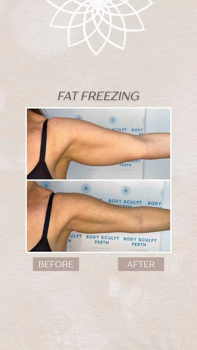 A little arm transformation 🤍
This beautiful client treated stubborn fullness with fat freezing — and the difference speaks for itself.

More definition. A smoother contour. More confidence in the little things 💫

It’s never about changing who you are — just refining what’s already there.

💌DM to see what we can do for you!

#BeforeAndAfter #ArmFreeze #BodySculptingCare #DefinedArms #bodysculptperth