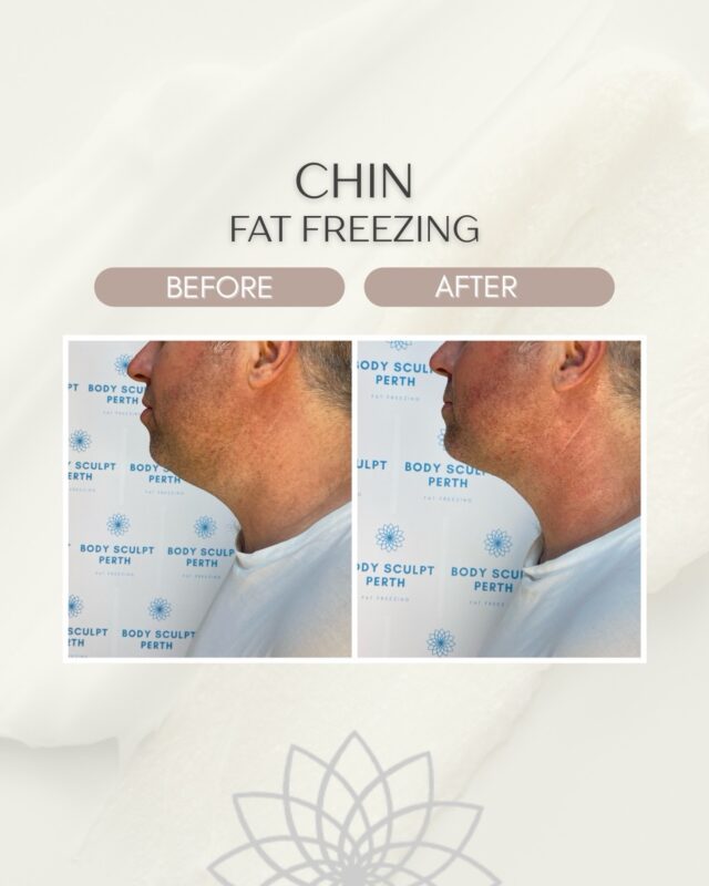 There’s a reason side profiles change the whole look of a face on men.

A stronger jawline and cleaner angle through the chin can completely shift the balance of the profile — even when the change itself is subtle.

Before & after under-chin Fat Freezing results for our client 👏

📨 Reach out if you’d like to know more about this treatment.

#bodysculptperth #fatfreezingperth #mensfatfreezing #jawline #sideprofile beforeandafter fatfreezingresults perthaesthetics