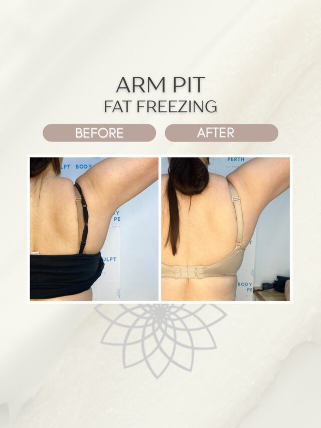 👌🏼 That little area just behind the armpit is something we see a lot in consults — especially when people are trying on fitted tops or bras and feel like something is sitting a bit “off”.

With our advanced Fat Freezing technology we are able to target all the little bits 💫

For us, it’s one of those treatments where the change can be quite subtle in photos but really noticeable in how your clothes fit and how confident you feel day to day.

📩 Send us a message if you want to learn more!

#bodysculptperth #fatfreezingperth #beforeandafter #sidebulge #underarmfat