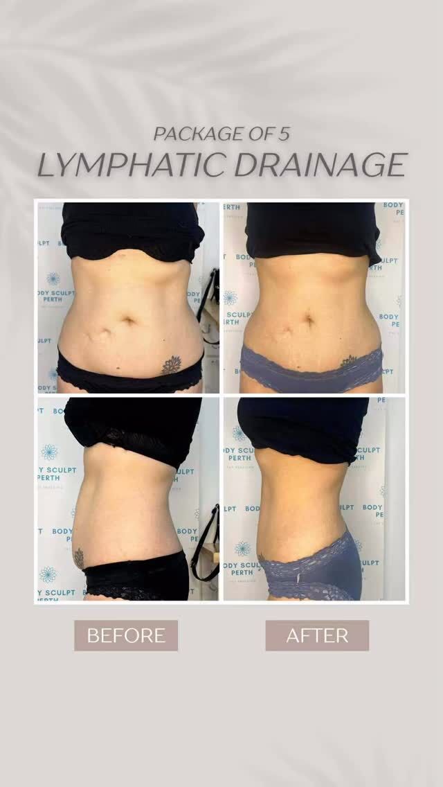 These before and after results are from just 5 lymphatic drainage treatments — it still amazes us every time 😍

It’s incredible how much fluid retention can change the way your body looks and feels.

💧When your lymphatic system is sluggish, everything feels heavier — tummy, waist, legs, even your energy levels.

With the right support, your body releases what it’s been holding onto:

• Less fluid
• Less bloating
• More definition
• More comfort
• A lighter, more balanced feeling all over

✨Sometimes it’s not “fat” — it’s fluid.
And lymphatic drainage can make a world of difference.

📩 DM us if you want to feel this shift too.

#BodySculptPerth #LymphaticDrainage #LymphaticMassage #PerthBeauty #PerthWellness #FluidRetention #DetoxPerth #Debloating #BeforeAndAfter #FeelLighter #BodyTreatment #PerthWomen #PerthWA #PerthLife #WellnessClinic #PerthSmallBusiness